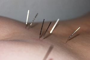 Akupunkturbehandlung im Rückenbereich